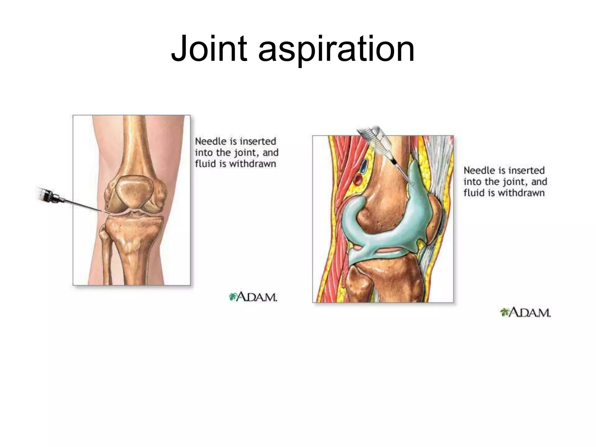Joint aspiration
 