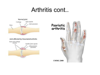 Arthritis cont..
 