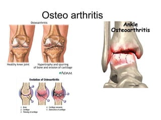 Osteo arthritis
 