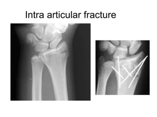 Intra articular fracture
 
