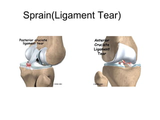 Sprain(Ligament Tear)
 