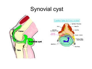 Synovial cyst
 