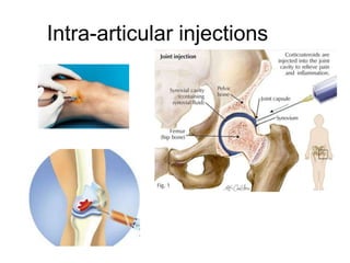 Intra-articular injections
 