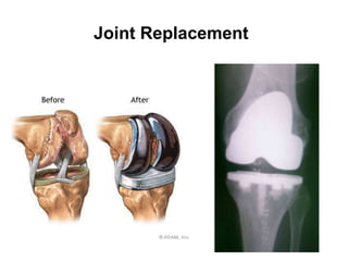 Joint Replacement
 