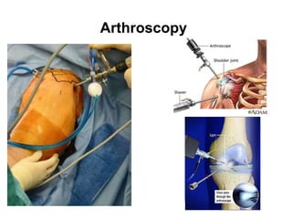 Arthroscopy
 