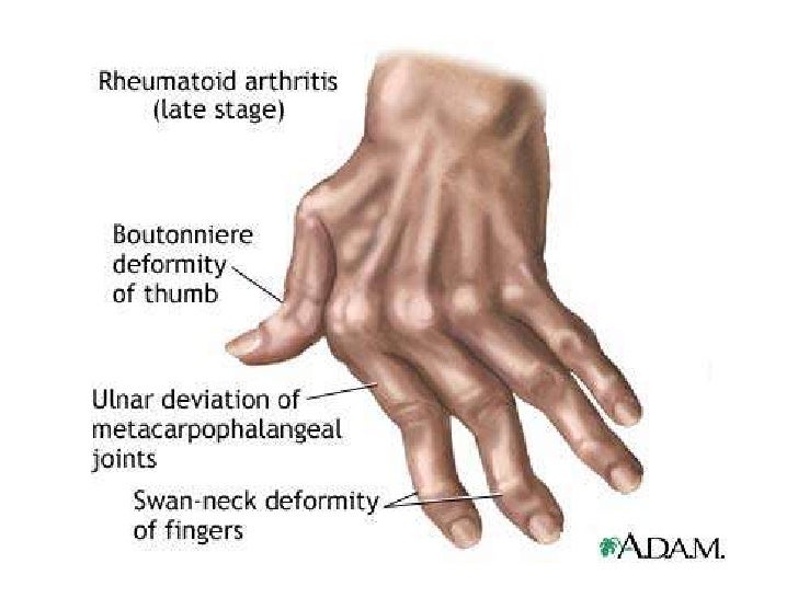 Joint syndrome differential diagnosis between scleroderma , dermatomy…
