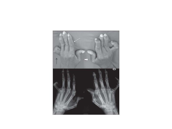 Joint syndrome differential diagnosis between scleroderma , dermatomy…