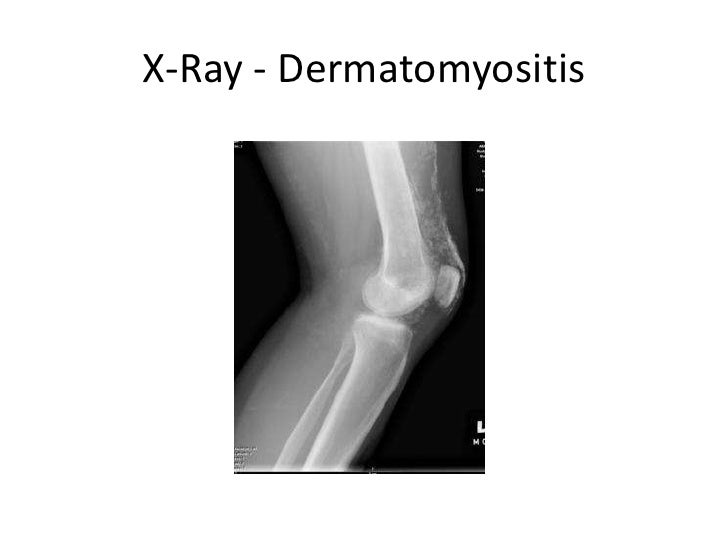Joint syndrome differential diagnosis between scleroderma , dermatomy…