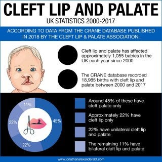 Cleft Lip and Palate Statistics UK 2000-2017