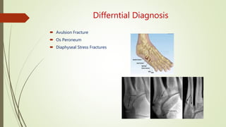 Differntial Diagnosis
 Avulsion Fracture
 Os Peroneum
 Diaphyseal Stress Fractures
 