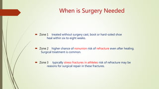 When is Surgery Needed
 Zone 1 treated without surgery cast, boot or hard-soled shoe
heal within six to eight weeks.
 Zone 2 higher chance of nonunion risk of refracture even after healing.
Surgical treatment is common.
 Zone 3 typically stress fractures in athletes risk of refracture may be
reasons for surgical repair in these fractures.
 