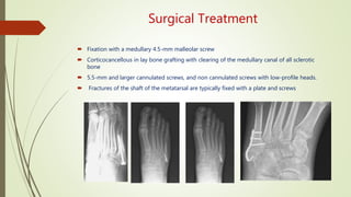 Surgical Treatment
 Fixation with a medullary 4.5-mm malleolar screw
 Corticocancellous in lay bone grafting with clearing of the medullary canal of all sclerotic
bone
 5.5-mm and larger cannulated screws, and non cannulated screws with low-profile heads.
 Fractures of the shaft of the metatarsal are typically fixed with a plate and screws
 