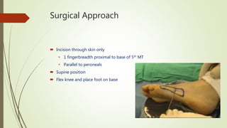 Surgical Approach
 Incision through skin only
• 1 fingerbreadth proximal to base of 5th MT
• Parallel to peroneals
 Supine position
 Flex knee and place foot on base
 