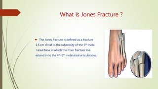 What is Jones Fracture ?
 The Jones fracture is defined as a fracture
1.5 cm distal to the tuberosity of the 5th meta
tarsal base in which the main fracture line
extend in to the 4th-5th metatarsal articulations.
 