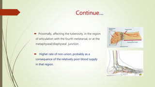 Continue…
 Proximally, affecting the tuberosity, in the region
of articulation with the fourth metatarsal, or at the
metaphyseal/diaphyseal junction.
 Higher rate of non-union, probably as a
consequence of the relatively poor blood supply
in that region.
 
