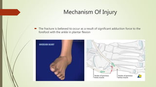 Mechanism Of Injury
 The fracture is believed to occur as a result of significant adduction force to the
forefoot with the ankle in plantar flexion
 