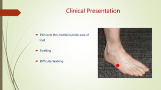 Clinical Presentation
 Pain over this middle/outside area of
foot
 Swelling
 Difficulty Walking
 
