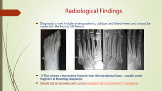 Radiological Findings
 Diagnostic x-rays include anteroposterior, oblique, and lateral views and should be
made with the foot in full flexion.
 X-Ray shows a transverse fracture near the metatarsal base , usually small
fragment & Minimally displaced.
 Should not be confused with normal apophysis of the proximal 5th metatarsal.
 