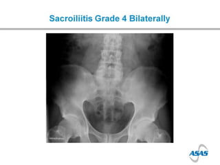 Spondyloarthropathies - Dr Jon Packham | PPTX