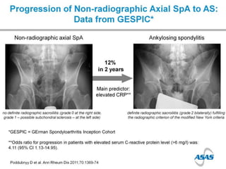 Spondyloarthropathies - Dr Jon Packham | PPTX