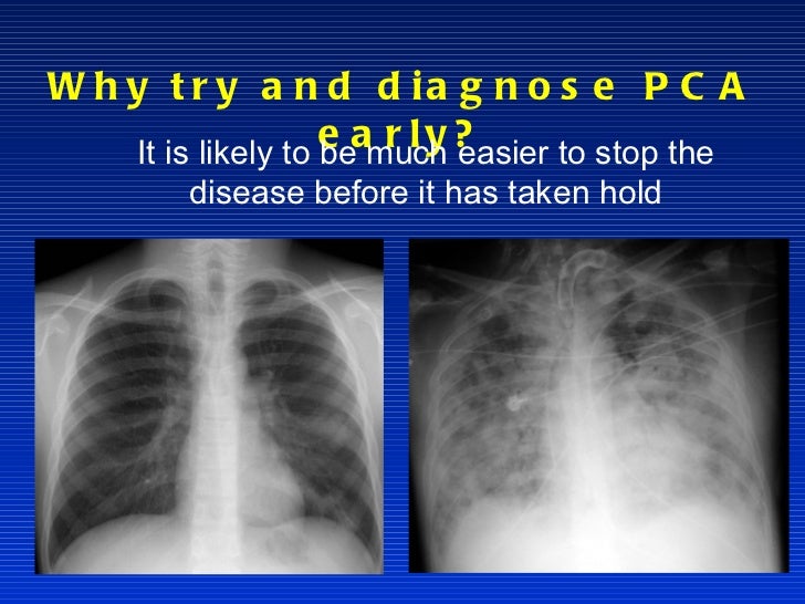 PCA Treatments By Jon Schott pca-treatments-by-jon-schott