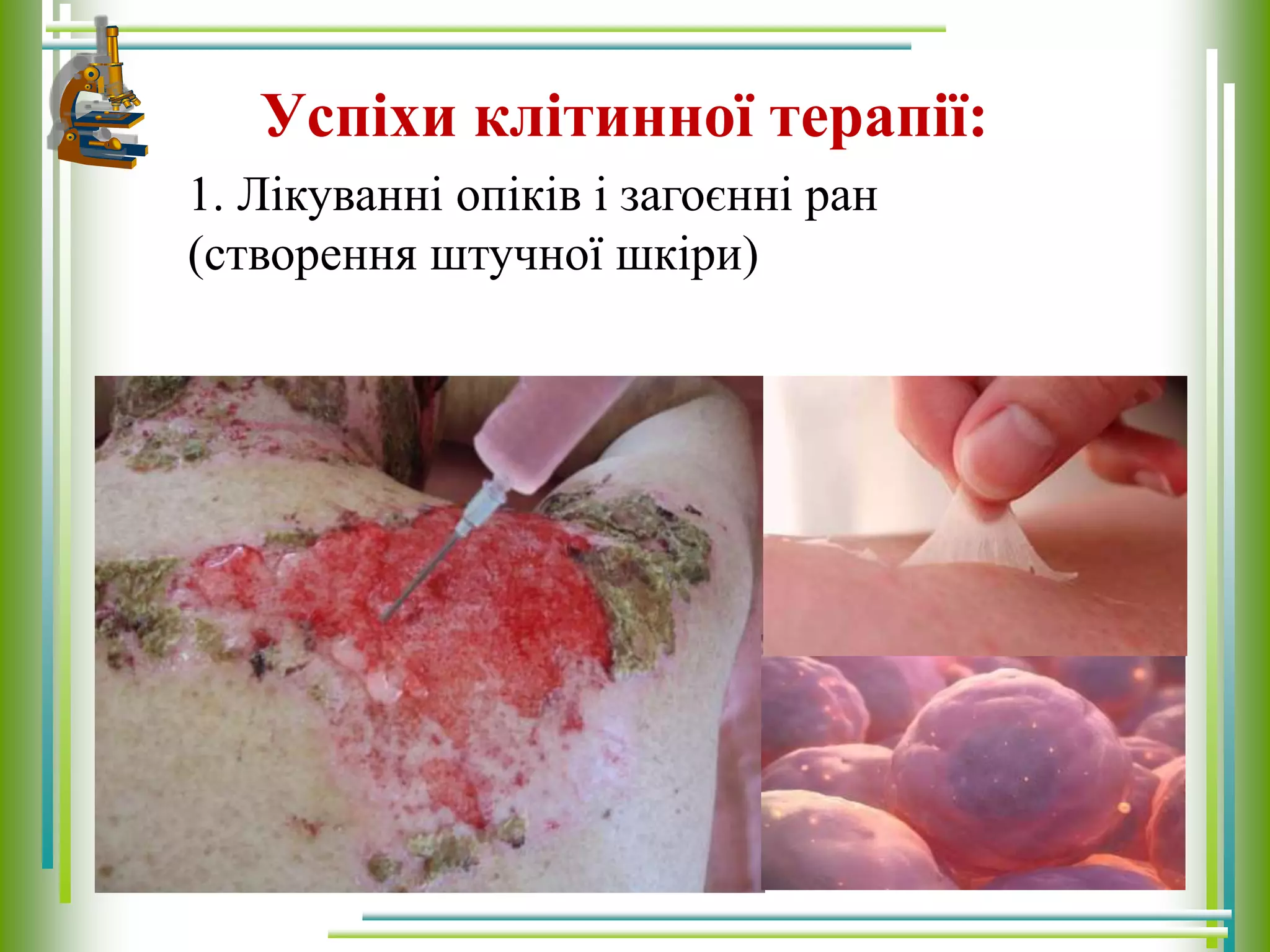 Успіхи клітинної терапії:
1. Лікуванні опіків і загоєнні ран
(створення штучної шкіри)
 