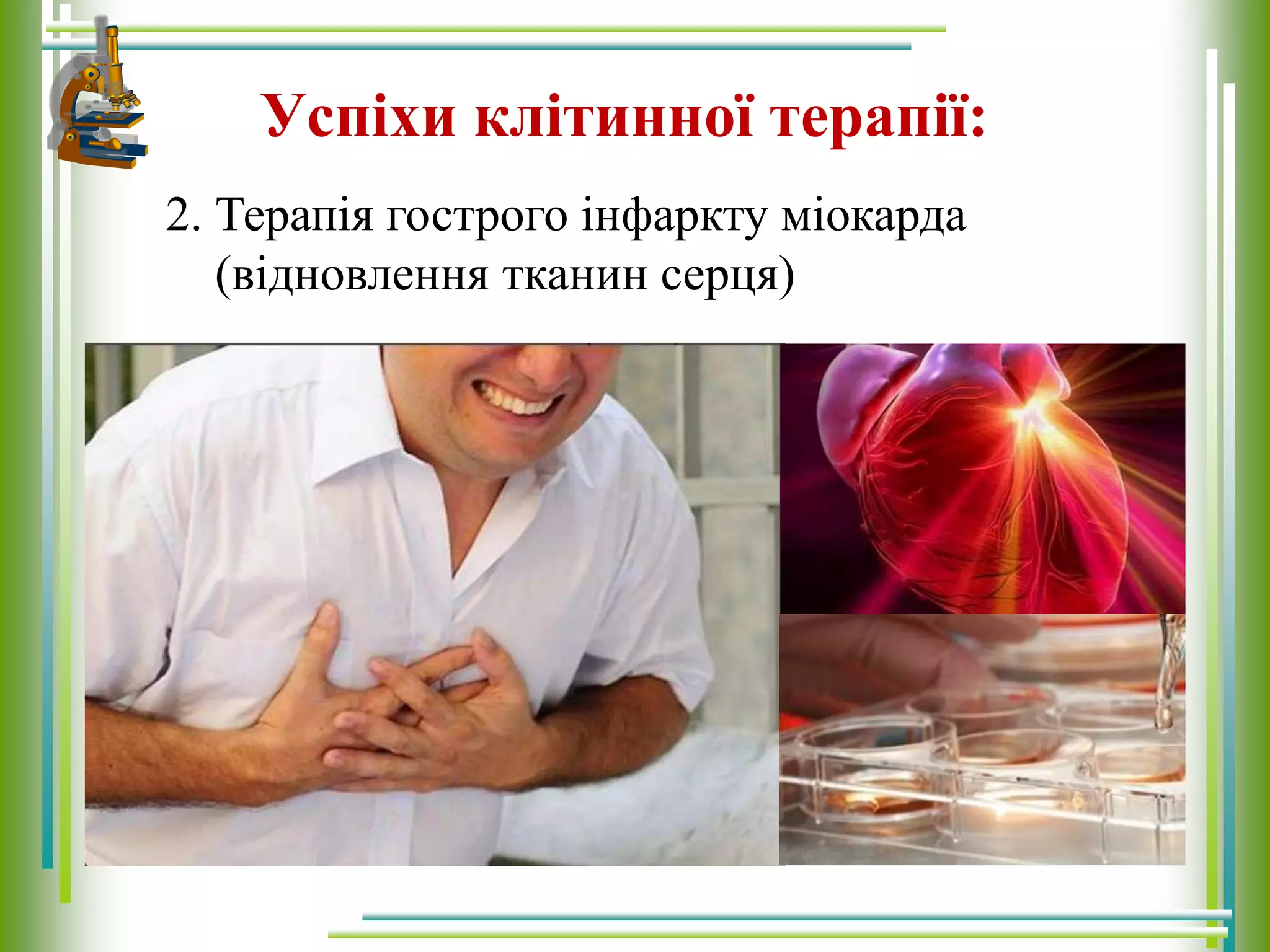 Успіхи клітинної терапії:
2. Терапія гострого інфаркту міокарда
(відновлення тканин серця)
 