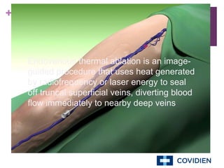Endovenous thermal ablation is an image-guided procedure that uses heat generated by radiofrequency or laser energy to seal off truncal superficial veins, diverting blood flow immediately to nearby deep veins . 