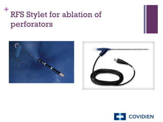 RFS Stylet for ablation of perforators 