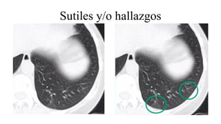 Sutiles y/o hallazgos
 