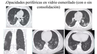 ●Opacidades periféricas en vidrio esmerilado (con o sin
consolidación)
 