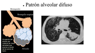 ● Patrón alveolar difuso
Bronquiolo terminal
Bronquilo respiratorio
Alveolo
 