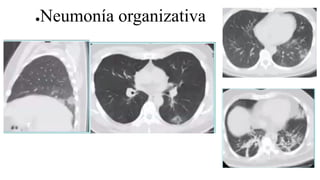 ●Neumonía organizativa
 
