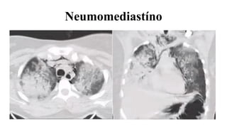 Neumomediastíno
 