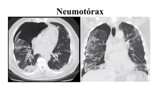 Neumotórax
 