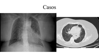 Casos
 