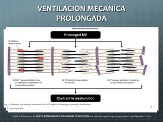 Scott K. Powers; et al. VENTILATOR-INDUCED DIAPHRAGM DYSFUCTION. Am j physiol regul integr comp physioL 305:R464-R477, 2013
VENTILACION MECANICA
PROLONGADA
 