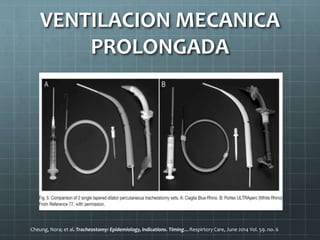 VENTILACION MECANICA
PROLONGADA
Cheung, Nora; et al. Tracheostomy: Epidemiology, indications. Timing…Respirtory Care, June 2014 Vol. 59. no. 6
 