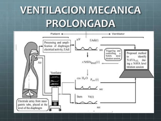VENTILACION MECANICA
PROLONGADA
 