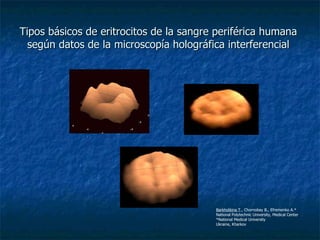Tipos básicos de eritrocitos de la sangre periférica humana  según datos de la microscopía holográfica interferencial  Barkhotkina T ., Chornobay B., Efremenko A.* National Polytechnic University, Medical Center *National Medical University Ukraine, Kharkov 