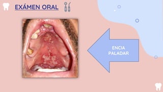 HISTOPLASMOSIS/ODONTOLOGIA/CASO CLINICO.pptx