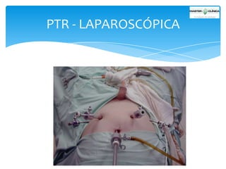 PTR - LAPAROSCÓPICA

 