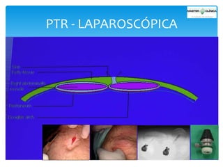 PTR - LAPAROSCÓPICA

 