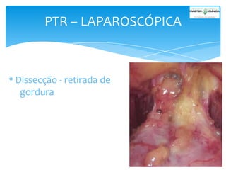 PTR – LAPAROSCÓPICA

* Dissecção - retirada de

gordura

 