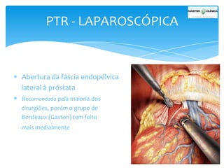 PTR - LAPAROSCÓPICA

Abertura da fáscia endopélvica
lateral à próstata
Recomendada pela maioria dos
cirurgiões, porém o grupo de
Bordeaux (Gaston) tem feito
mais medialmente

 