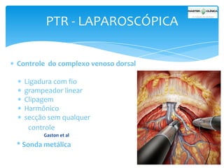 PTR - LAPAROSCÓPICA
Controle do complexo venoso dorsal
Ligadura com fio
grampeador linear
Clipagem
Harmônico
secção sem qualquer
controle
Gaston et al

* Sonda metálica

 