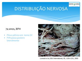 DISTRIBUIÇÃO NERVOSA

74 anos, BPH
• Plexo pélvico em torno SV
• FVN passa postero
lateralmente

Lunacek et al, BJU International, 95, 1226-1231, 2005

 