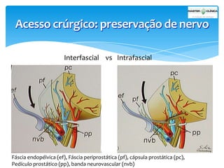 Acesso crúrgico: preservação de nervo
Interfascial vs Intrafascial

Fáscia endopélvica (ef), Fáscia periprostática (pf), cápsula prostática (pc),
Pedículo prostático (pp), banda neurovascular (nvb)

 
