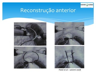 Reconstrução anterior

Patel et al – solcimi 2008

 