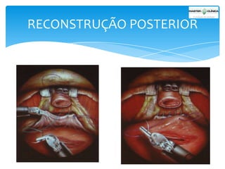 RECONSTRUÇÃO POSTERIOR

 